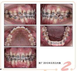 定型磨牙垫成人能用吗视频,视频揭秘口腔健康新选择