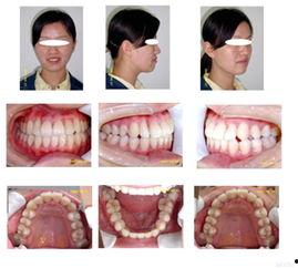 定型磨牙垫成人能用吗视频,视频揭秘口腔健康新选择