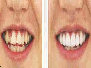 成人双排牙能磨掉吗视频